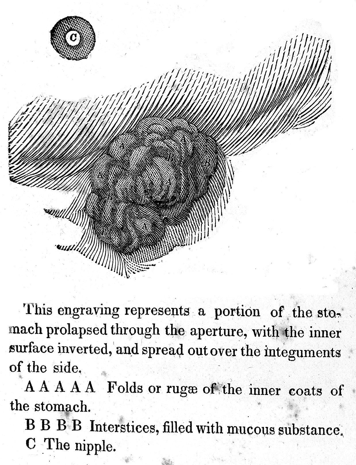 William Beaumont Logo - File:Prolapsed stomach, William Beaumont, 1833 Wellcome L0005180.jpg ...