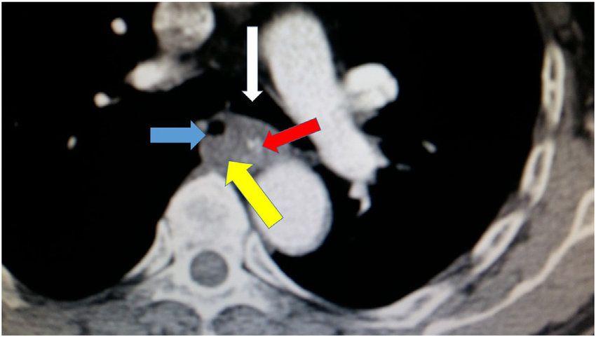 Red and White Arrow Logo - Blue arrow: indicates esophagus, Red arrow: indicates necrosis ...