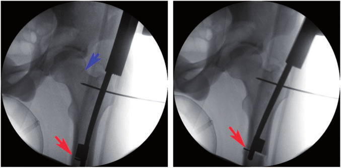 Left Right Arrow Blue Red Logo - Fluoroscopic images of intramedullary saw (red arrow) before (left ...