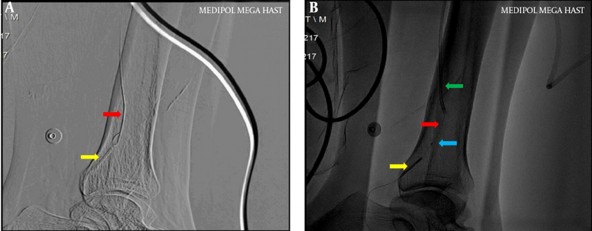 Red and Yellow Arrow Logo - A, Yellow Arrow, Fluoroscopic Appearance of the Embolized Catheter