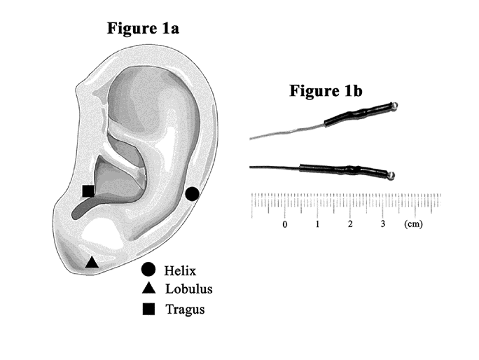 Three Black Triangle Logo - a) Three points stimulated on the left ear. Black circle, black ...