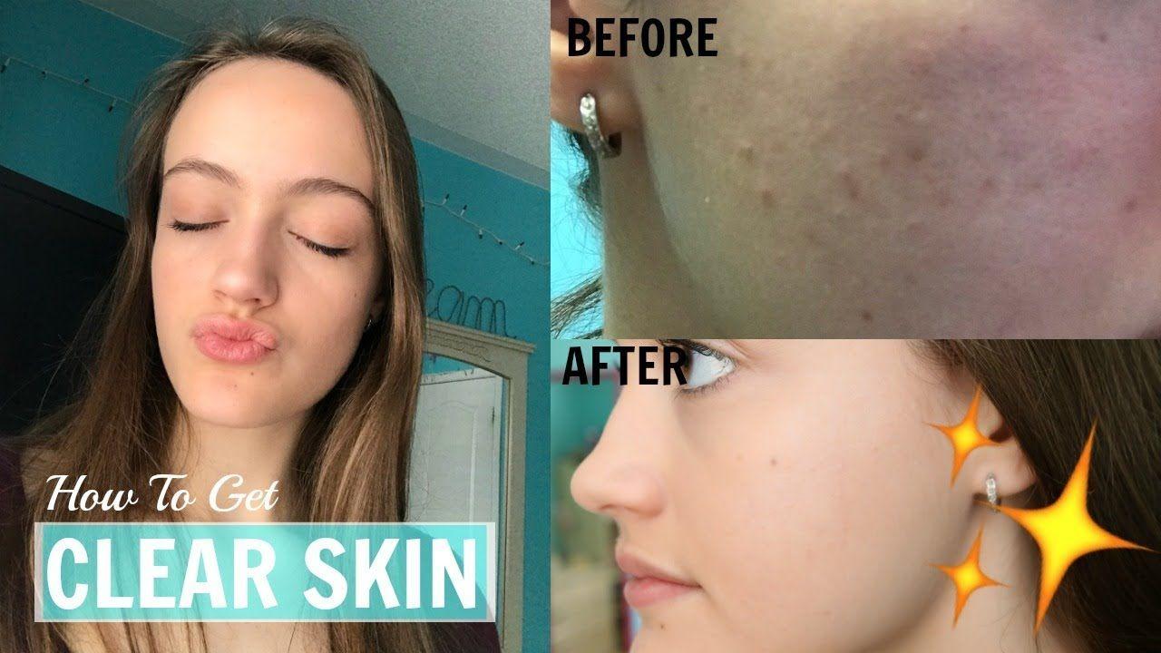 Clear Skin Dermatology Logo - How to Get CLEAR Skin! What my Dermatologist Told me.. Acne Tips