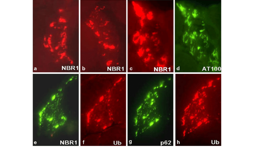 Squiggly Red C Logo - Immunolocalization Of NBR1 Within S IBM Muscle Fibers. A, B