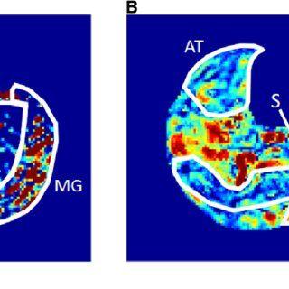 Plds Logo - ASL perfusion maps computed using a single PLD (A) and multiple PLDs ...