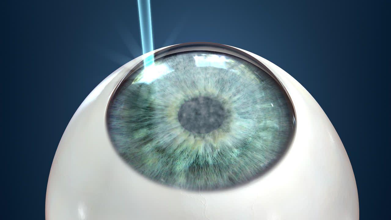 IntraLase Logo - IntraLase LASIK Video | State Of the Art Laser Eye Treatment | Optimax