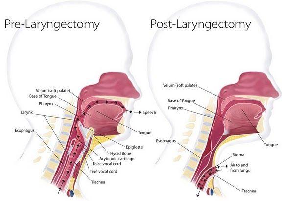 Trach Logo - Laryngectomy