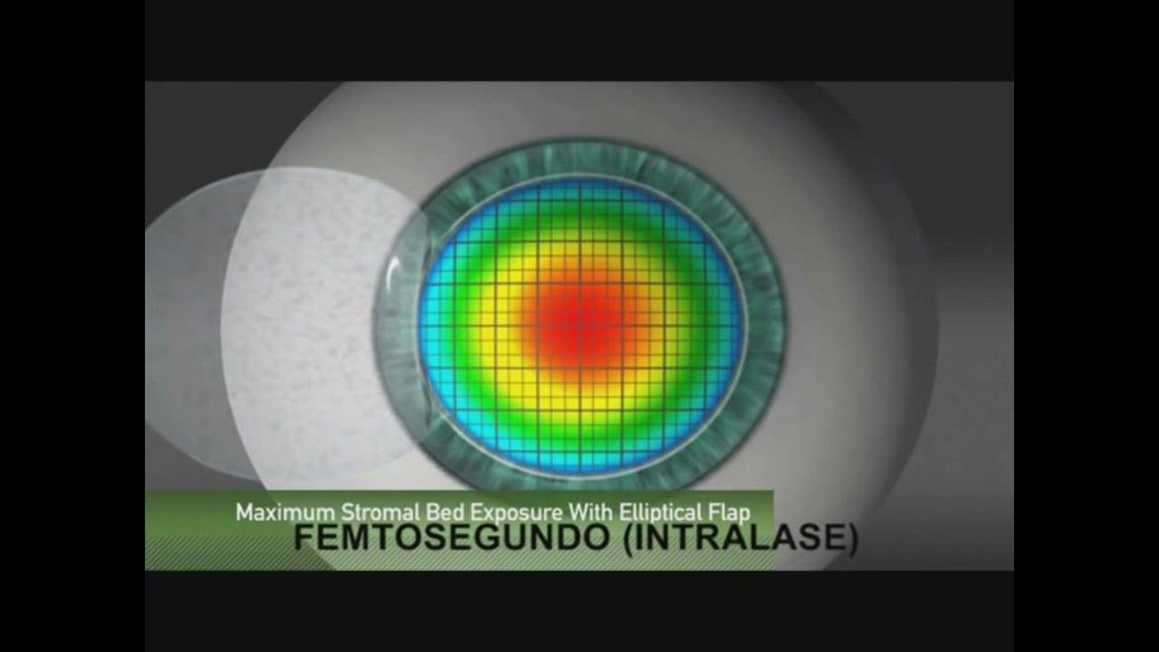 IntraLase Logo - Microqueratomo vs Femtosegundo (Intralase) en cirugía LASIK