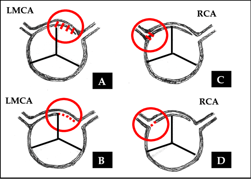 LMCA Logo - Diagram representation of surgical repair of an anomalous left main