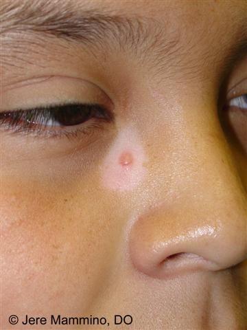 White Circle Red Dot Logo - Halo Moles - American Osteopathic College of Dermatology (AOCD)