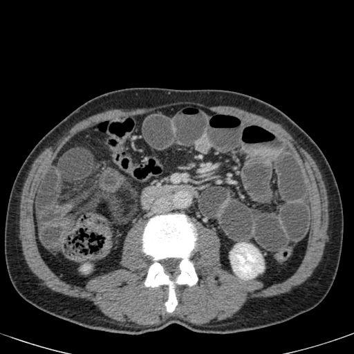 White Circle Red Colon Logo - The Radiology Assistant : Small bowel obstruction - Case 1