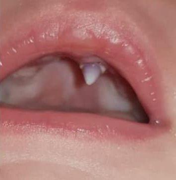 Vampire Mom Fang Logo - This Mom Got Worried When Her 2-Month Old Baby Grow A Tooth, A Sharp ...