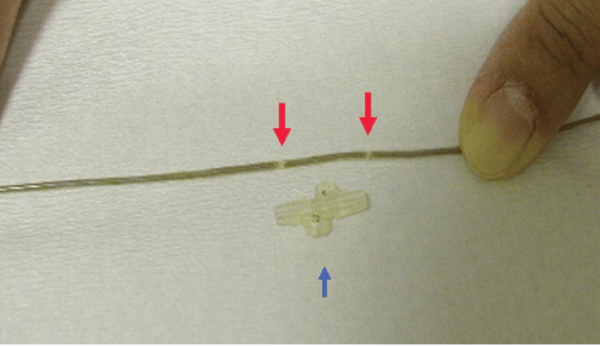 Anchor Blue Red Arrow Logo - Withdrawn lead wire. The red arrows indicate the break sites. The ...