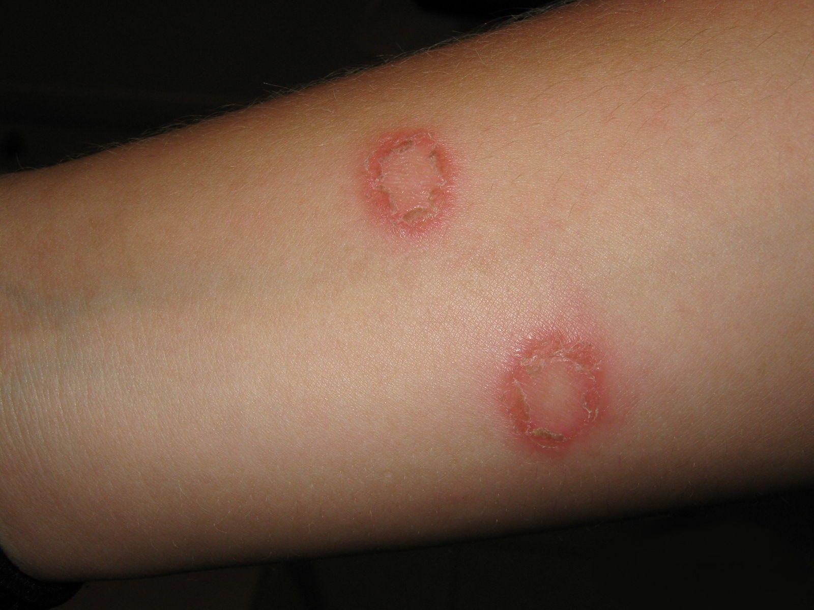 Red Circle with White Spot Logo - Ringworm