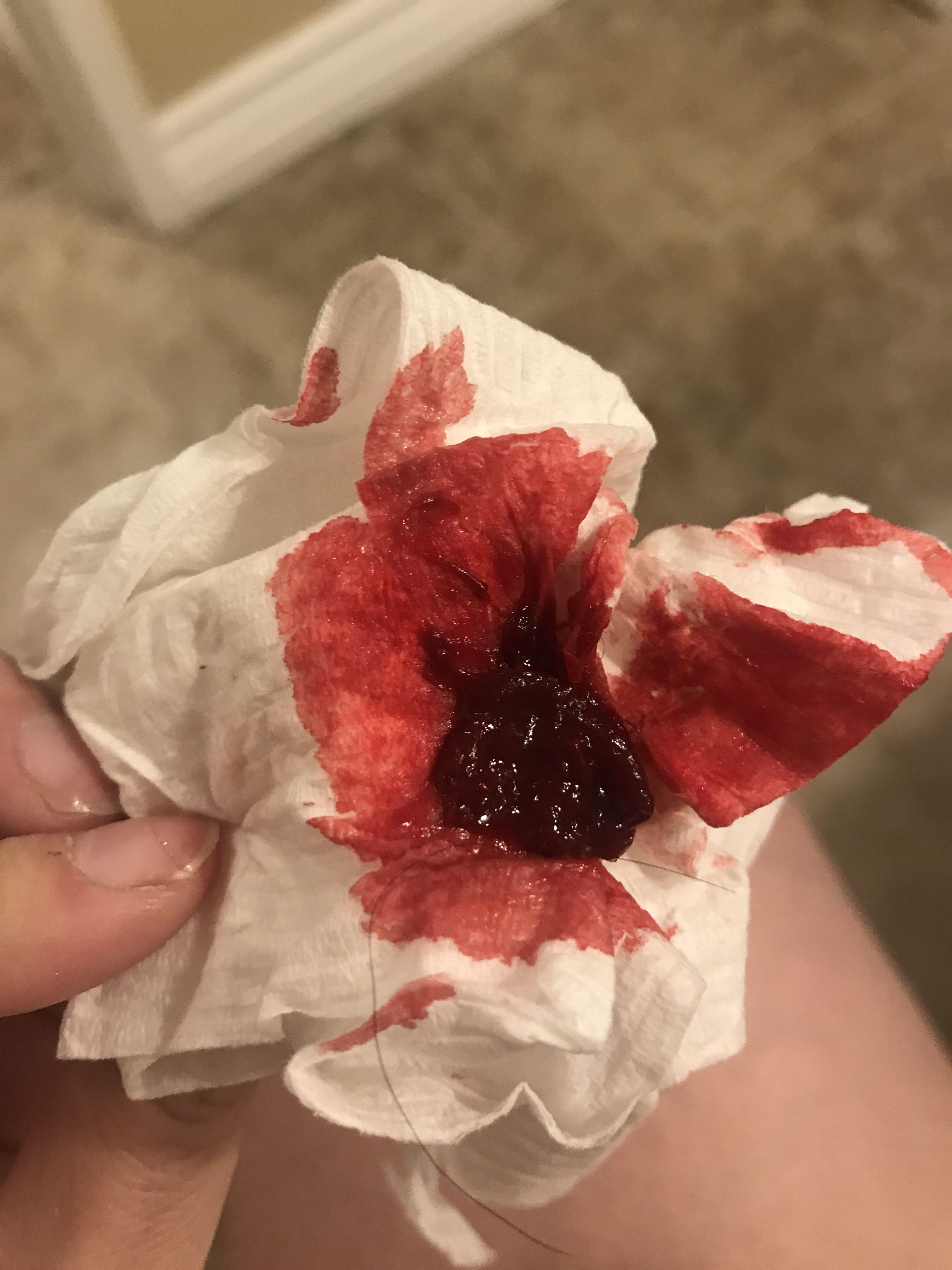 Red Bleeding ER Logo - Please help! Clot and blood after sex!! - October 2018 Babies ...