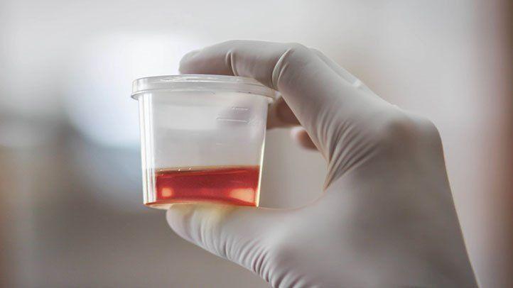 Red Bleeding ER Logo - What Causes Blood in Urine (Hematuria)? | Everyday Health