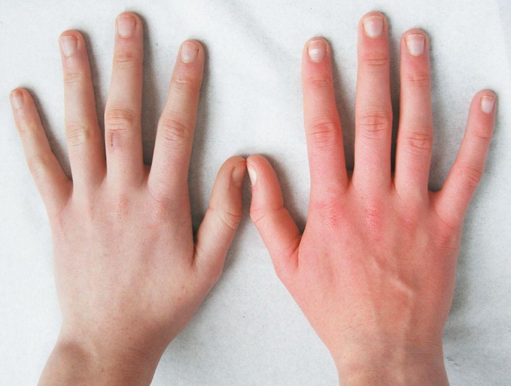 White and Red Hand Logo - A White Hand and a Red Hand — Erythromelalgia | NEJM