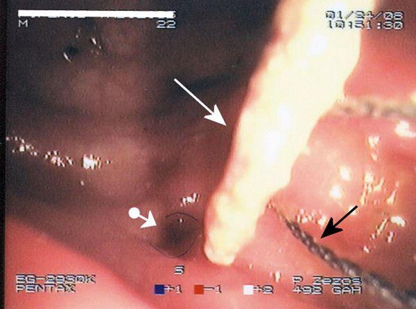 Colon White with Red Ball Logo - Endoscopic view of a toothpick impacted in the wall of sigmoid colon ...