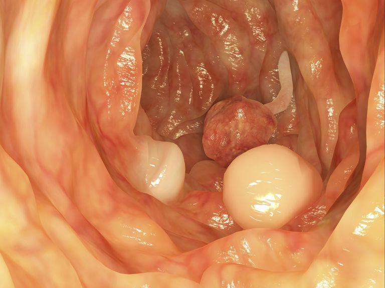 Colon White with Red Ball Logo - Colon Polyps and Cancer Risk