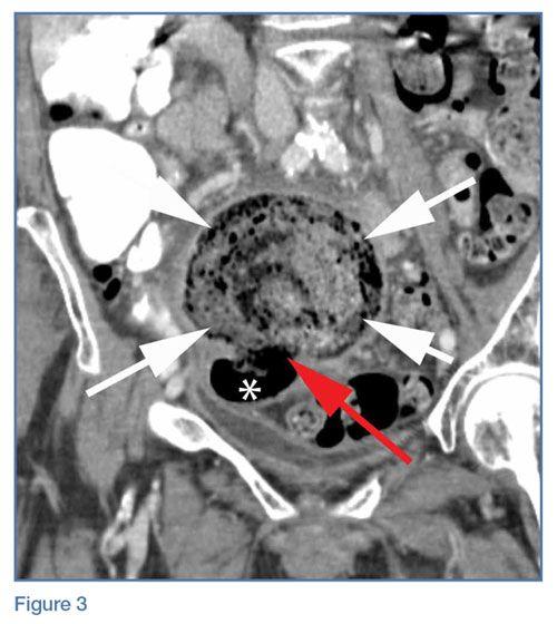 Colon White with Red Ball Logo - Emergency Imaging: Acute abdominal pain. MDedge Emergency Medicine