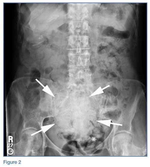 Colon White with Red Ball Logo - Emergency Imaging: Acute abdominal pain. MDedge Emergency Medicine