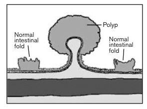 Colon White with Red Ball Logo - The Facts about Colorectal Polyps. Roswell Park Comprehensive